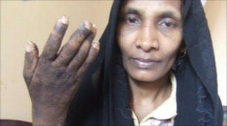 A Sri Lankan domestic worker shows her arm which she says was harmed by her employers (photo credit:Dushiyanthini Kanagasabapathipillai/Human Rights Watch)