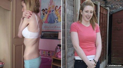 Rachael Johnston - during and after anorexia