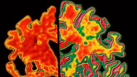 An image of a brain with Alzheimer's and one without