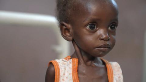 Two-year-old boy, Sulaiman, who is severely malnourished. 