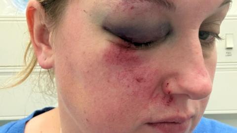 Sharon with a black eye and some grazing on her face. she is wearing a blue top and has fair hair in a pontyail