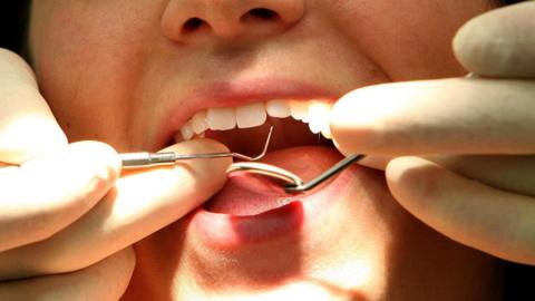 Dental instruments being held in the open mouth of a patient by a pair of hand wearing white surgical cloves.