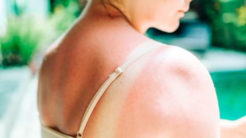 Woman having painful sunburn on her back and shoulder - stock photo
