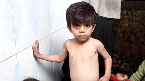 Malnourished Syrian boy