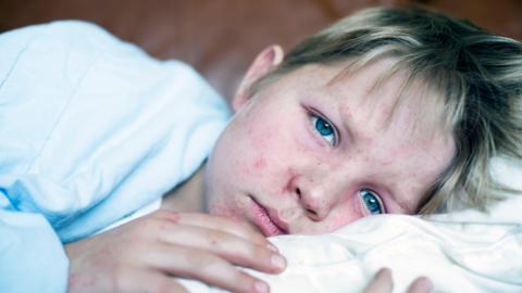 A young boy is lying on a pillow. He has red blotches on his face. He looks sad.