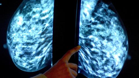 A doctor looks at a breast cancer scan