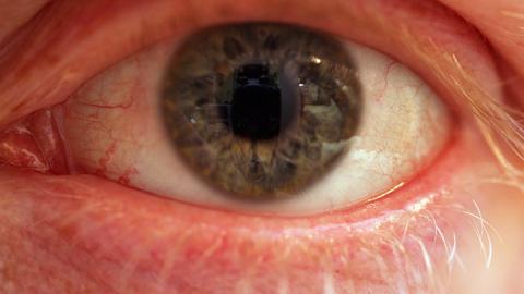 A bloodshot eye