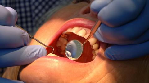 A close up of a patient's open mouth while a dentist wearing gloves holds a mirror and an looks inside her mouth.