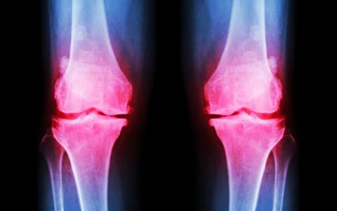 Medical bone scan of human legs showing osteoarthritis in the knees