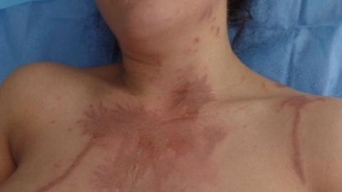 Phoebe Georgiou's chest showing acid burns