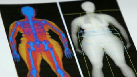 DEXA scan results show body fat