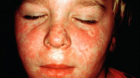 Measles rash on child's face