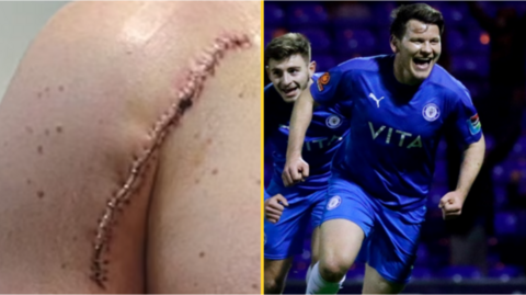 Connor Jennings (right) and his shoulder where the tumour was cut out