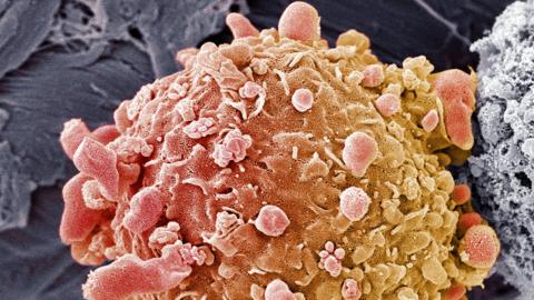 Melanoma