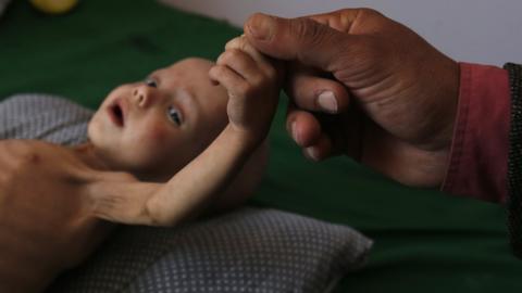 A malnourished Yemeni child receives treatment at a hospital in Sanaa, Yemen (15 November 2017)