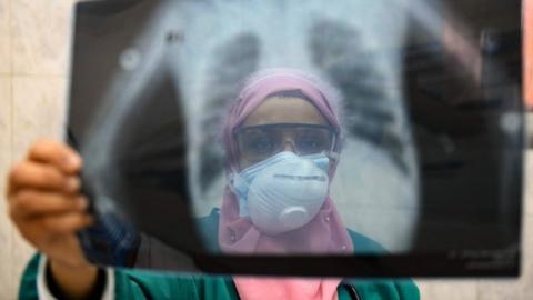 An Egyptian doctor looks at a chest x-ray at a hospital in Cairo (19 April 2020)