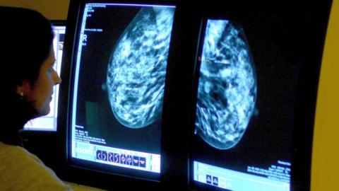 File photo of a consultant analysing a mammogram of a woman's breast in order check for breast cancer.