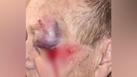 The man's facial injuries