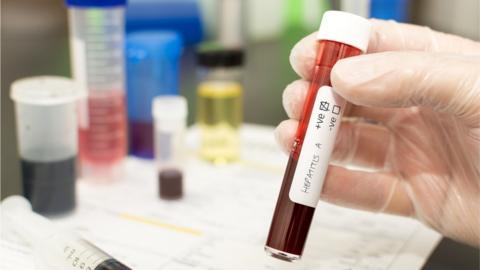 A Hepatitis A blood test