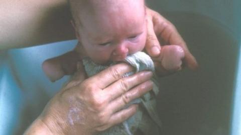 Lisa McManus as a baby in the bath with shortened arms