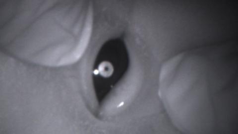 Cataract picked up by Neocam