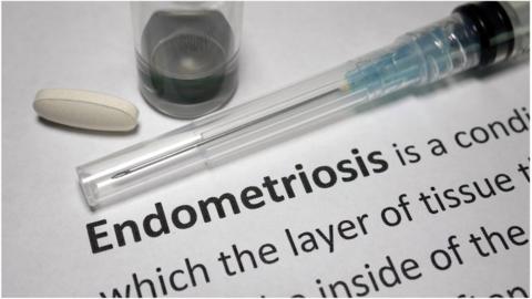 Endometriosis definition photo