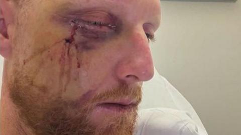 Ben Stokes recovering from facial surgery