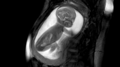 Baby in the womb