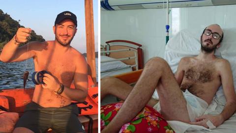 Calvin Hill before (left) and after sepsis