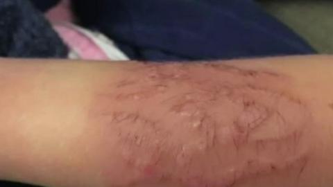 Burnt arm