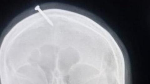 An x-ray of the nail stuck through the woman's head