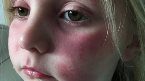 Florence, aged four, with a scarlet fever rash on her face