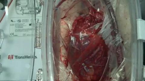 Heart beating in transplant machine