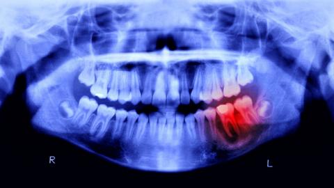 X-ray of teeth