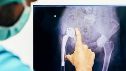 A surgeon points to a hip on an X-ray