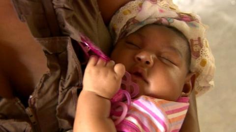 Child born with effects of the Zika virus