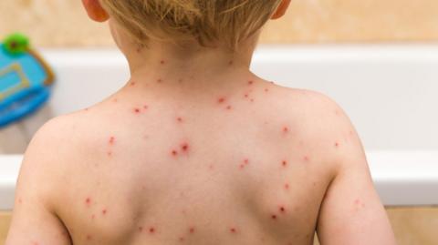An image of a young child's back with red spots. 