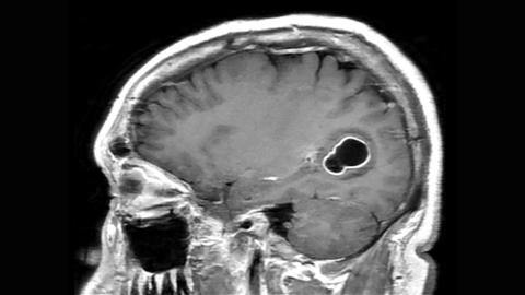 This sagittal (from the side) T1 weighted MR image of the head with contrast enhancement shows a cystic lesion in the temporal-occipital region of the brain. The cyst is dark and the surrounding low signal is the inflammatory edema. There is peripheral enhancement along the wall of the cyst compatible with active infection. This is a lesion related to infection from eggs of the pork tapeworm (taenia solium)