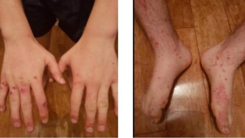 Cowpox lesions on the boy's hand and feet