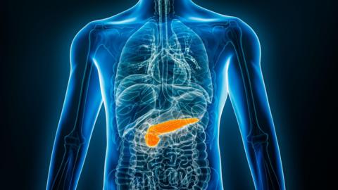 Dealbh x-ray de chom neach leis a' bhrisgean-mhilis air a chomharrachadh le dath oirains