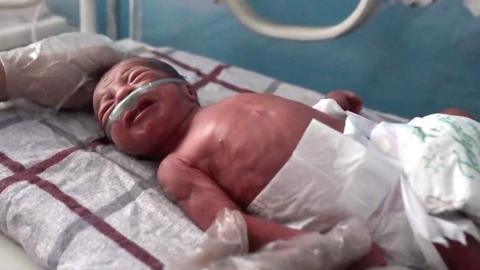 A premature baby boy delivered at 7 months