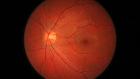 Retinal photo