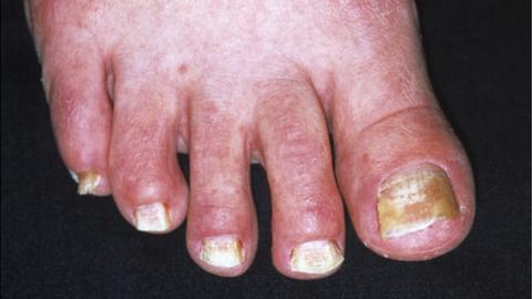 Fungal infection in the toenails
