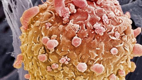 Skin cancer cell