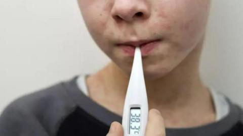 A close up of the bottom half of a young child's face - there is a blotchy rash on the youngster's face, and a thermometer in their mouth