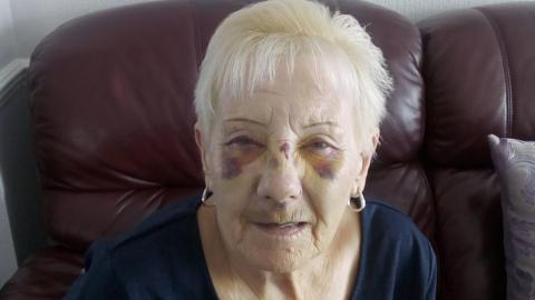 Lyn Garrard looks directly at the camera. Her eyes and nose are covered in yellow and purple bruises after her fall. She has short peroxide blonde hair and wears small silver hoop earrings and a dark blue round neck cotton t shirt. Lyn sits on a burgundy leather padded sofa.