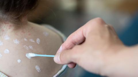 Hands applying cream on a cotton bud to a little girl with chicken pox at home. The background is blurred. Red spots are on the girl's neck and back.