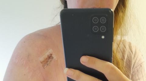 A selfie of Natalie showing her bare shoulder with a wound covered by micropore tape. She is holding the phone directly in front of her face