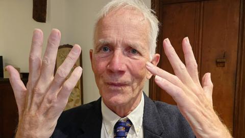 Graham Watson holds up his hands which show signs of muscle wastage caused by Motor Neurone Disease, that mean he can no longer operate on patients. 