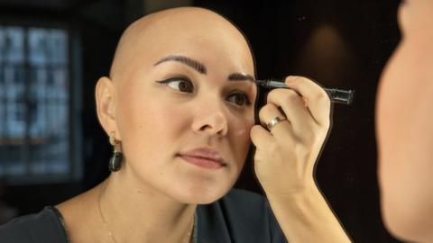 Woman with alopecia